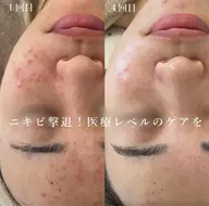 《しつこいニキビケア！細胞レベルで撃退！！》REVI陶肌トリートメント◎¥21,480→¥15,400