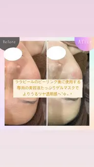 速攻トーンアップ◎美肌に感動🫶韓国美容NO.1❤️韓国肌管理ピーリング🩷肌を剥かずに育てる⭐️