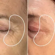 蓄熱式超音波！✨年齢を感じるたるみに最適！！その場でリフトアップを実感✨スキンケアも今までと同じではどんどん老けますよー