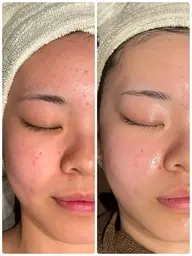 平日限定✨当店No.1✨バイオセルショット35➕ハイドロ(毛穴洗浄)