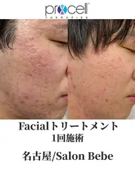 【初回特別20%OFF】通常¥50,000→¥40,000|マスクなし、ノーファンデでハリ艶肌へ