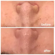 ⭐️ミニモ限定⭐️毛穴洗浄・ハイドラフェイシャルコース60分