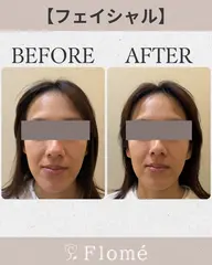 【フェイシャル】お顔からデコルテまで、アフターケアにも⭐️(お顔からデコルテまで20分)機械でアプローチ