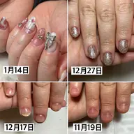 深爪矯正　再来のみ