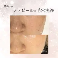 【艶肌毛穴レス‼️】韓国式3D毛穴洗浄✖️ララピール✨通常¥27,800→¥13,800