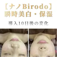 【エステ版ダーマ】シミ・ニキビケア・美白★究極の肌質改善フェイシャル