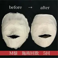 💠小顔人気No,3 【立体小顔】小顔コルギ×石膏パック×デコルテマッサージ