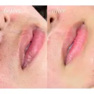 🫧🩰🌿【肌艶UP】フルフェイスWax🌿🩰🫧🉐¥3,400(額、鼻、頬、口元)