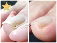 中度以上の巻爪カット