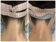 【女性】圧倒的仕上がり◎首元美人＊まとめ髪も◎ワックス＋光【うなじMIX脱毛】¥4400