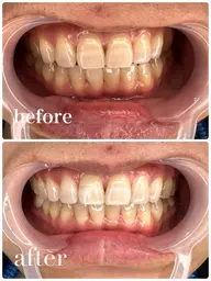 【4回券🎫】驚きの早さでトーンアップ！全8回照射(10分✖️2照射の4回分)🦷ハイパワーセルフホワイトニング✨