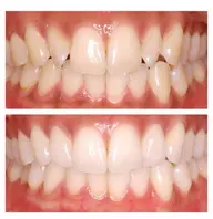 4月14日限定🉐セルフホワイトニング🦷✨