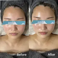 【毛穴・くすみ・乾燥まとめてケア】REVIハーブピーリング🌿陶肌トリートメント＋エンザイム1g＋VCF0.8ml