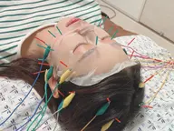 【ミニモ限定🦔口コミ投稿ご協力→初診料無料】ヒト幹細胞電気美容鍼🪡