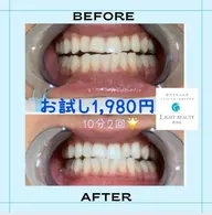 初めての方必見✨1回で効果抜群🌈🦷やって良かったの声多数✨ホワイトニングが今だけ1,980円❣️10分✖️2照射🌟