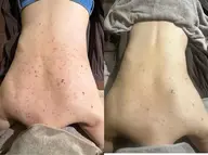 【剥離あり】背中🌿ハーブピーリング