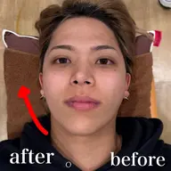 【メンズ応援メニュー💆♂️】小顔矯正×顔脱毛