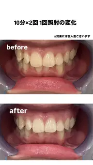 歯のホワイトニング10分×2回　3回回数券