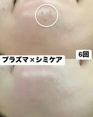 【徹底シミケア 10分】プラズマ導入✕美白トラネキサム酸導入透明感UP