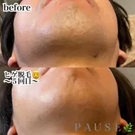 🥸メンズ脱毛🥸ひげALLセット一回コース