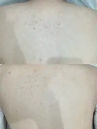 [イベント前に🎈] うなじ背中脱毛⭐️