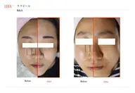 【第4世代水光肌ピール】お肌のトラブルはお任せ下さい☺️💕肌質/ワンホン/韓国肌/タマゴ肌/透明肌