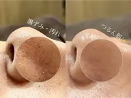 【平日限定◎】韓国毛穴洗浄▸▸高濃度生炭酸で毛穴の黒ずみ/開き/角栓/毛穴詰まり/ザラつきを集中ケア︎︎👋🏻 ̖́-
