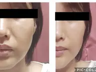 パイラナイトフェイシャル✨🍀リフトアップしたい方🍀艶、ハリがほしい方🍀ほうれい線改善したい方など