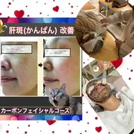 《剥がれないピーリング特許施術》カーボンピーリングコース