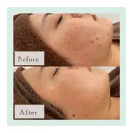 【REVI シミケア】