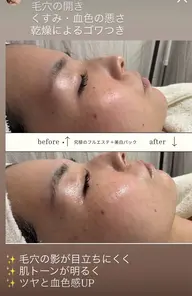 うる艶卵肌フルエステ