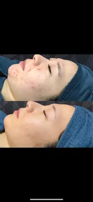 【ニキビ肌、アトピーの方もOK✨】ピーリング導入しました🌿