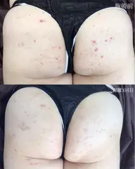 【お尻ハーブピーリング】ニキビ・黒ずみ★剥離あり・なし選択可※Google口コミ必須