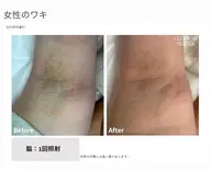 🖤ミニモ限定🥀　脇脱毛🌸