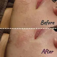 【毛穴汚れ撃退🍓】毛穴エクストラクション 60分 ¥4400【メンズも歓迎✨】