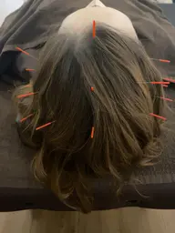 自律神経&睡眠改善!ドライヘッドスパ鍼灸100分(足浴含む)