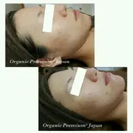 自己再生治癒力を高める！ニキビ毛穴開き肌荒れシワ ニードルパウダーorハーブピーリングコース　70分