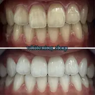 【浦和で人気のホワイトニング】【リーズナブル×圧倒的効果】 ¥8,800→¥3,980🦷💎✨️