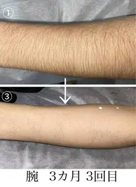 【初回限定】全身脱毛(顔のみ)