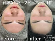 【症例モニター募集｜先着3名様】剥離なしDTなし🌿調合式ハーブピーリング《毛穴・乾燥・くすみでお悩みの20​〜​30代》