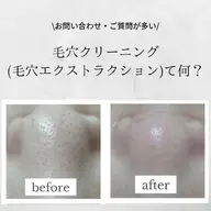 学生様限定✨黒ずみ・詰まり毛穴クリーニングエステ