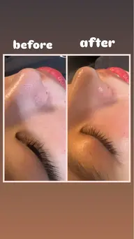 【人気✨】毛穴洗浄フェイシャルスペシャル