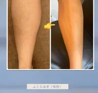 【男性限定】ダントツお悩みの〈足全体×腕全体〉2部位脱毛