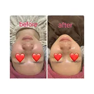 ①⭐️モニター価格⭐️2900円　フェイシャル小顔💎最新リフトアップ機器💎4000shot⭐️お顔と顎下超お得