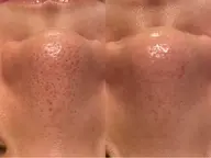 ミニモ初回限定価格!【結果重視】毛穴徹底洗浄×吸引×鎮静ケア※鼻のみ