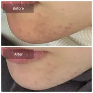 ニキビ肌！治したい！そんなあなたも１度お試しください🌷🫧(シートパック付／高保湿モデリングパック変更可)