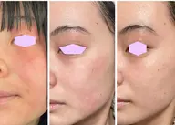 ★花粉症皮膚炎や日焼けの炎症肌、湿疹、赤ら顔、ハリの低下によるしわ、レストセル60分