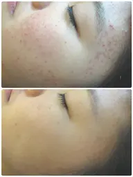 《アクネ改善にも◎》韓国式3D毛穴洗浄×ララピール