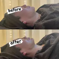 【メンズ専用】最新3Dリフト6000ショット→肌別トリートメント→パック導入EMS✨