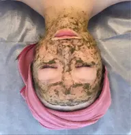 ハーブピーリング1g¥5,500＋【小鼻🍓毛穴黒ずみ】パックプレゼント🩶